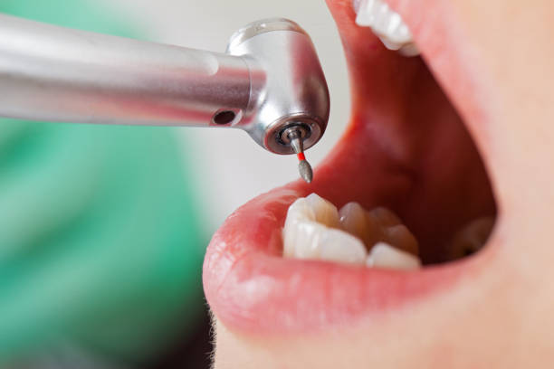 Best Emergency Tooth Extraction in San Antonio, TX
